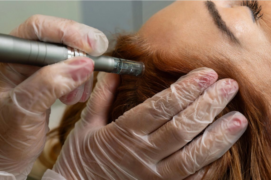 What is Scalp Microneedling